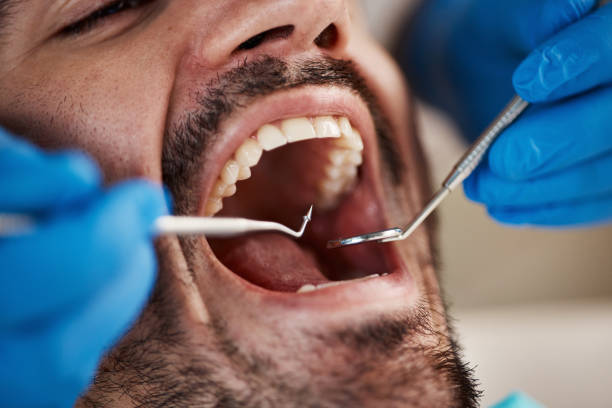 Best Emergency Wisdom Tooth Extraction in Council Bluffs, IA