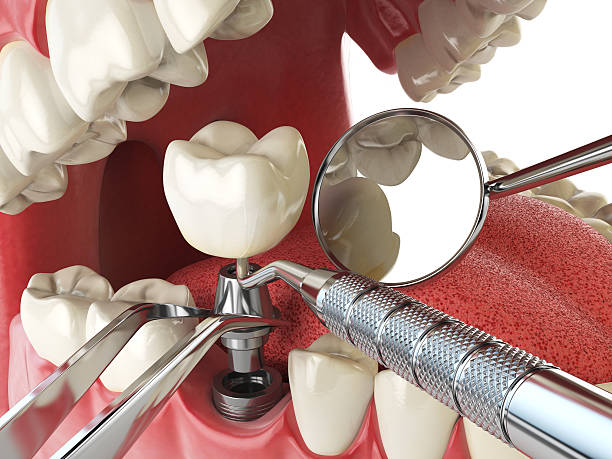 Best Emergency Root Canal Therapy in Council Bluffs, IA